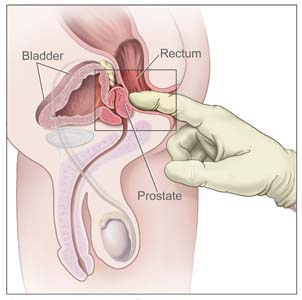 digital-rectum-exam-prostate.jpg